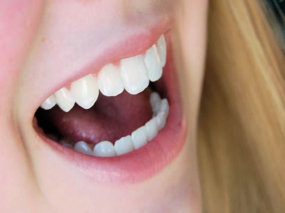 Teeth Whitening